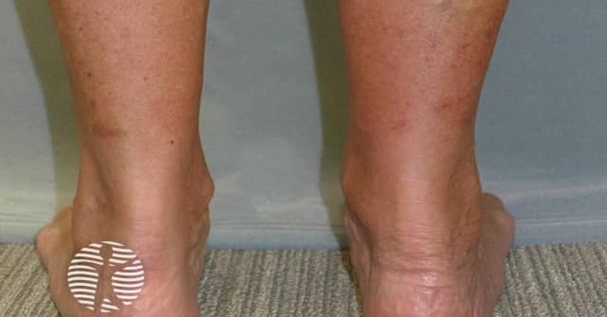 Exerciseinduced vasculitis image