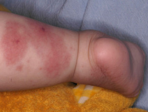 Finkelstein disease or acute haemorrhagic oedema of infancy