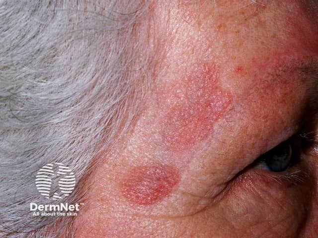 Red-brown plaques of granuloma faciale on the temple