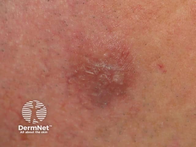A red-brown plaque of granuloma faciale on the temple - scale is unusual