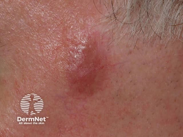 A shiny red-brown plaque of granuloma faciale on the cheek
