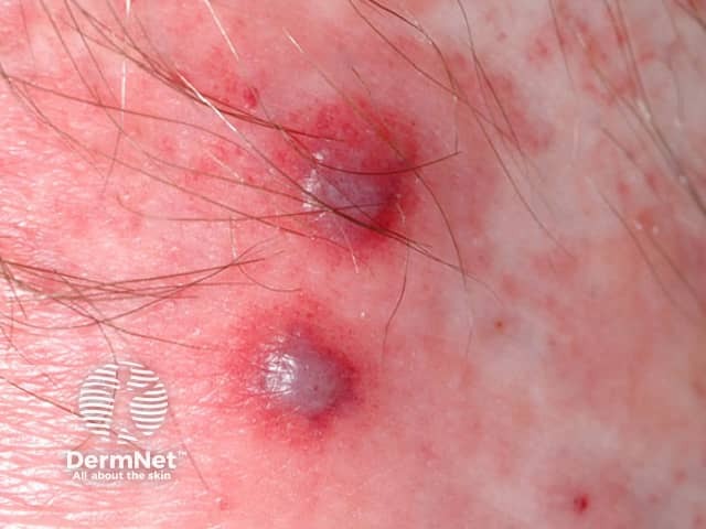 Close-up of purpuric rash with vesicle (blister) formation