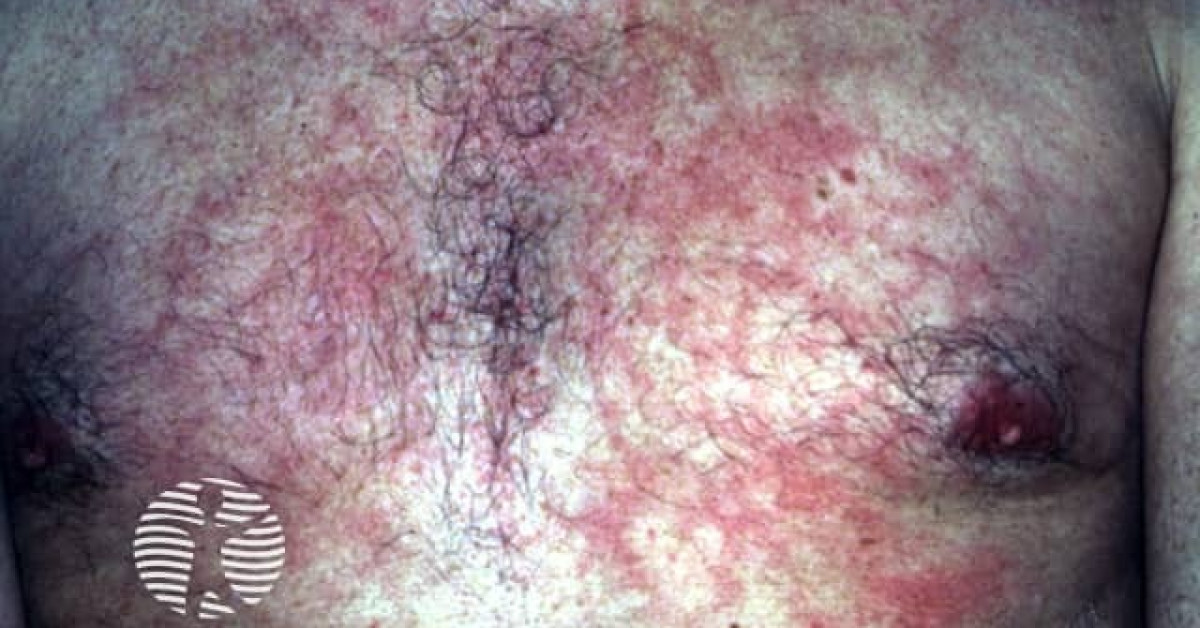 Dermnet Erythema Ab Igne Image