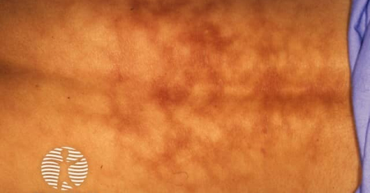 Erythema ab igne image