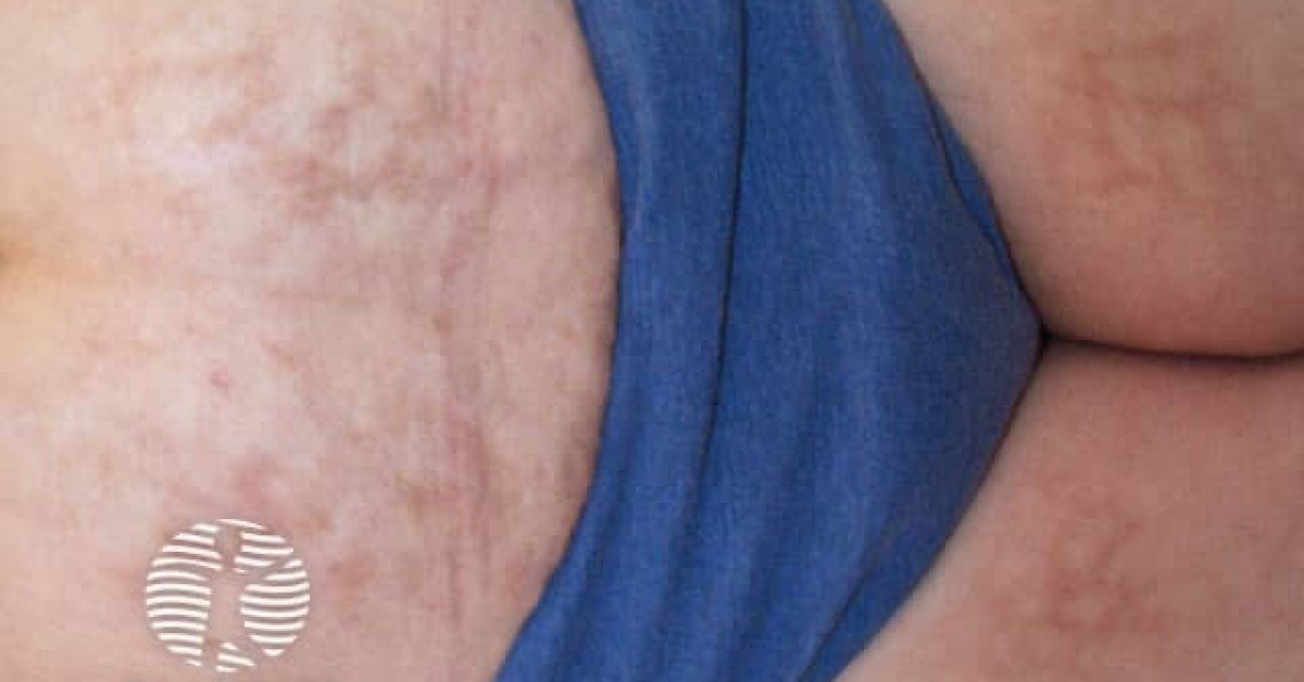 Erythema Ab Igne Image