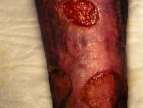Cutaneous polyarteritis nodosa