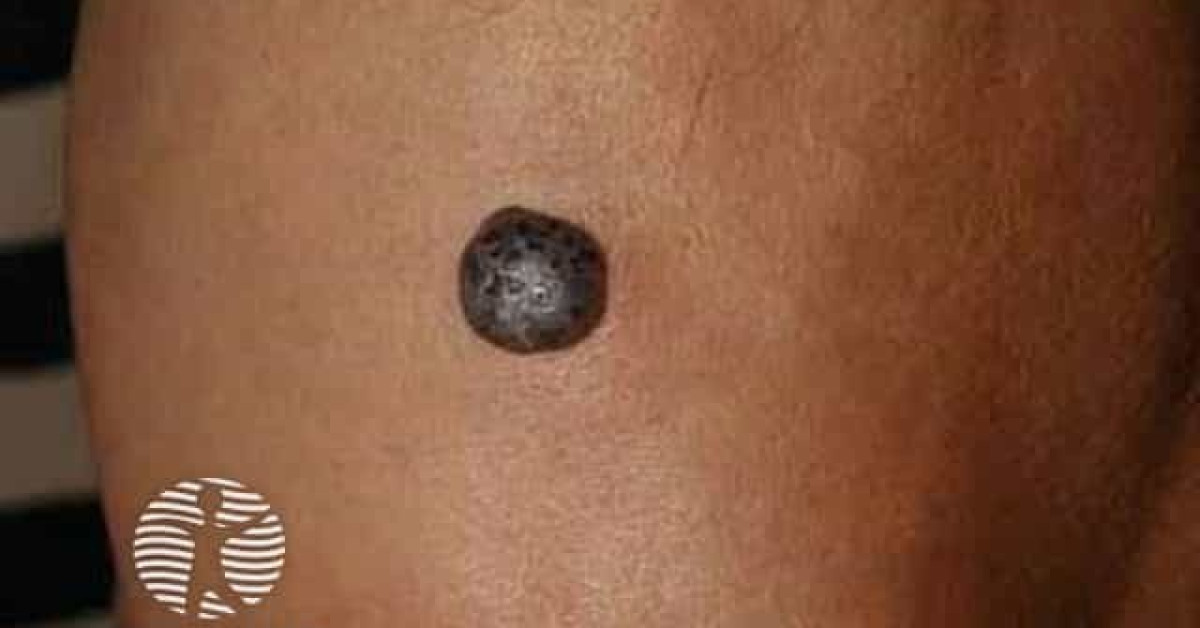 DermNet® - Haemangioma resembling nodular melanoma image