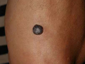 Haemangioma resembling nodular melanoma