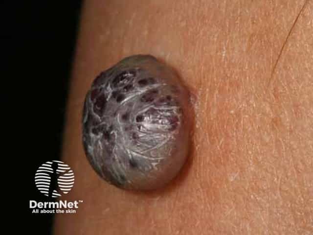Cherry angioma resembling nodular melanoma