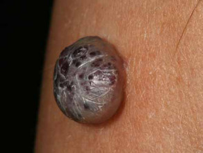 Haemangioma resembling nodular melanoma