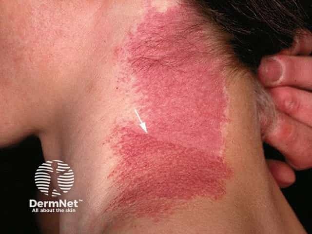 Port-wine stain - effect of laser treatment