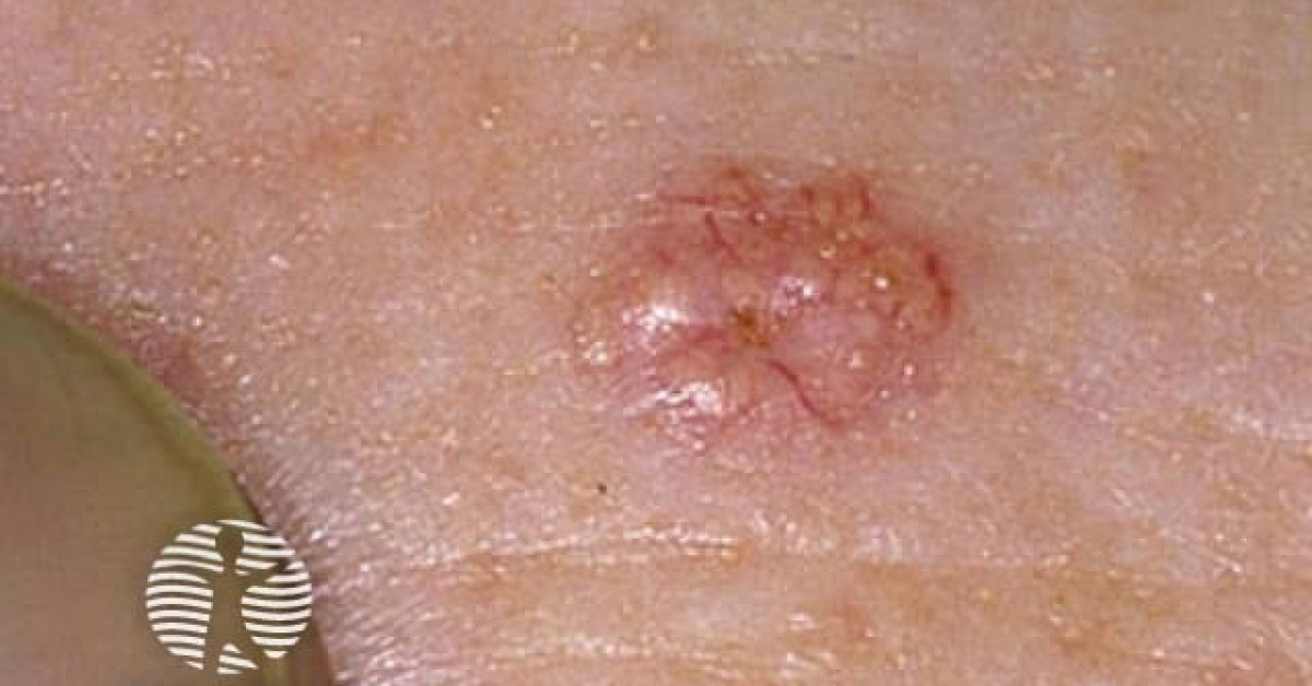 Sebaceous hyperplasia image