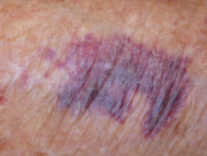 Did scar turn purple why my Why did