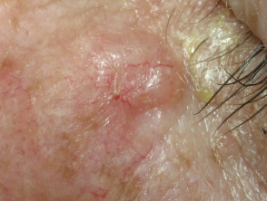 Telangiectasia in basal cell carcinoma