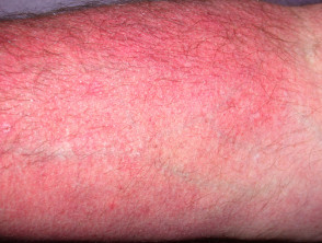 Telangiectasia due to topical steroid