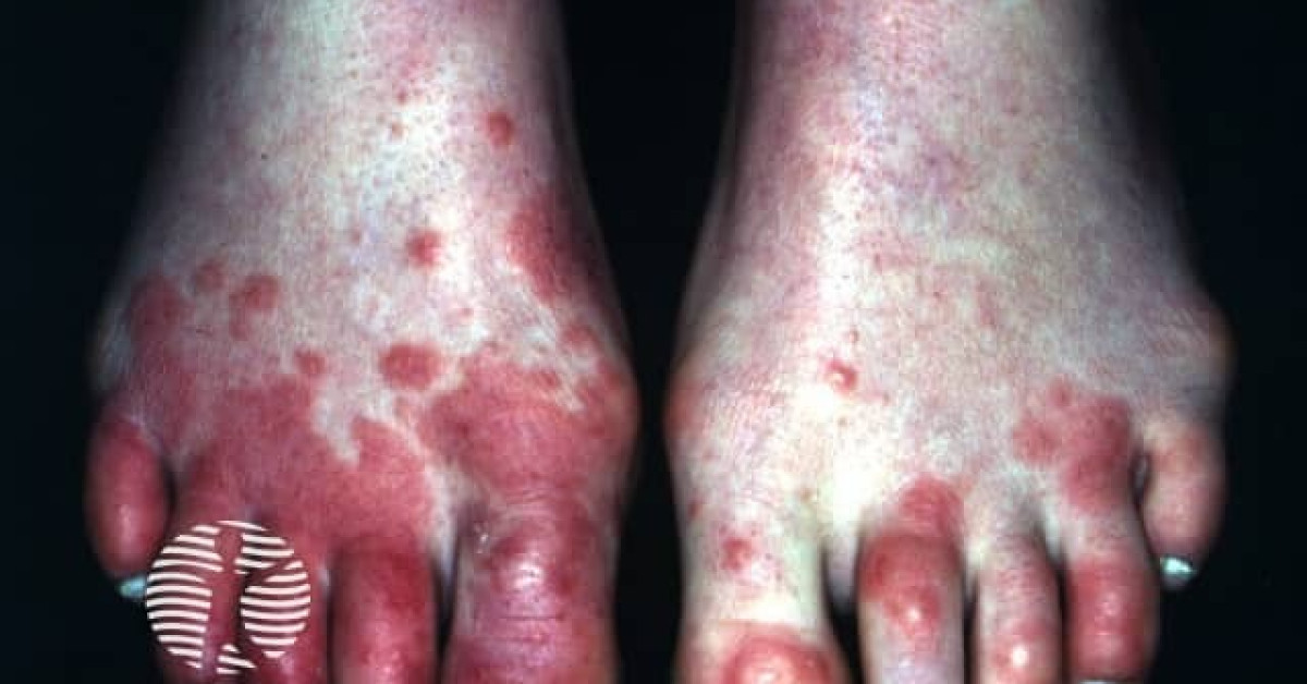 cutaneous vasculitis icd 9