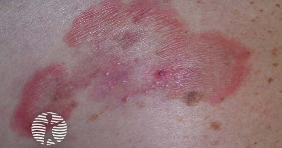 Vasculitis image