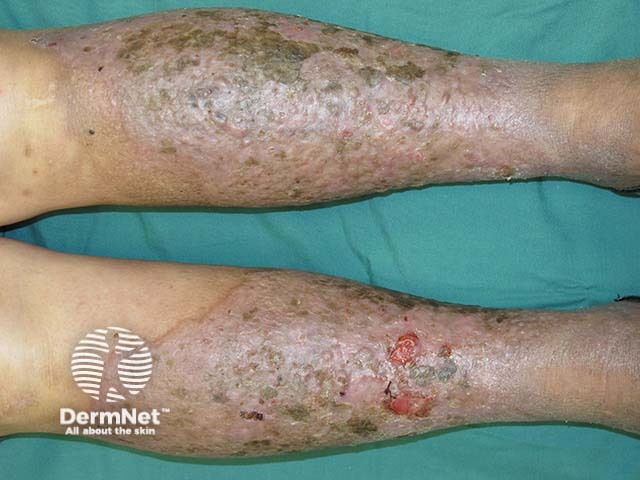 Venous dermatitis and ulceration