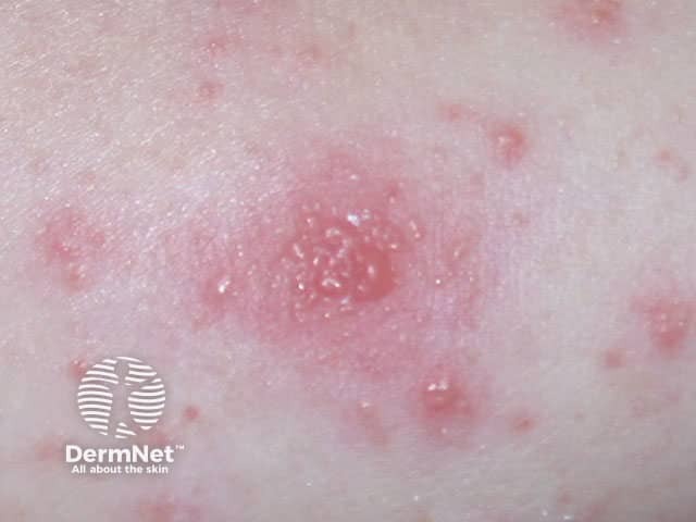Vesicles due to eczema