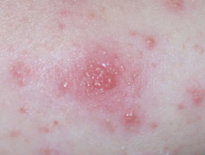 staph infection diaper rash