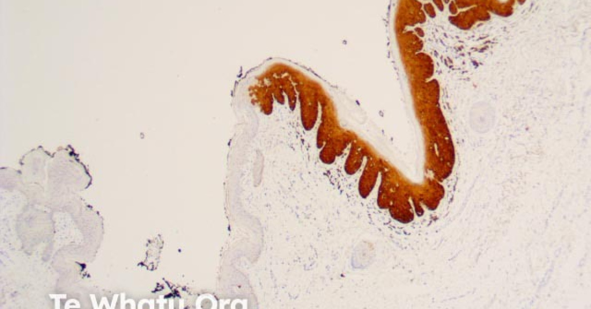 DermNet® - Vulval intraepithelial neooplasia pathology with p16 stain ...