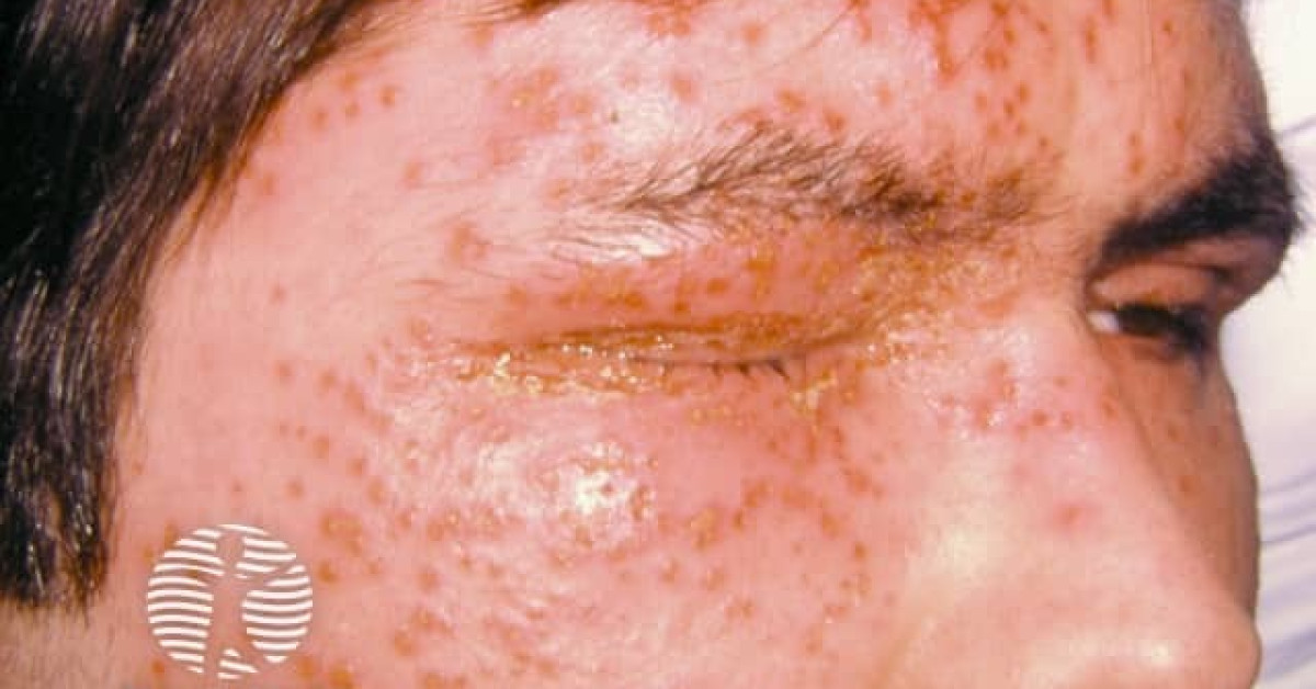 Eczema herpeticum image