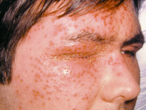 Eczema Herpeticum Images Dermnet Nz