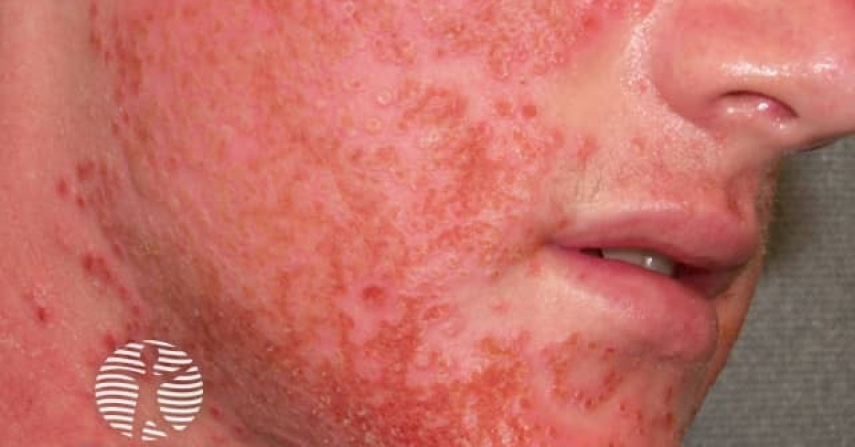 Eczema herpeticum image