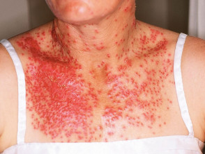 Eczema herpeticum