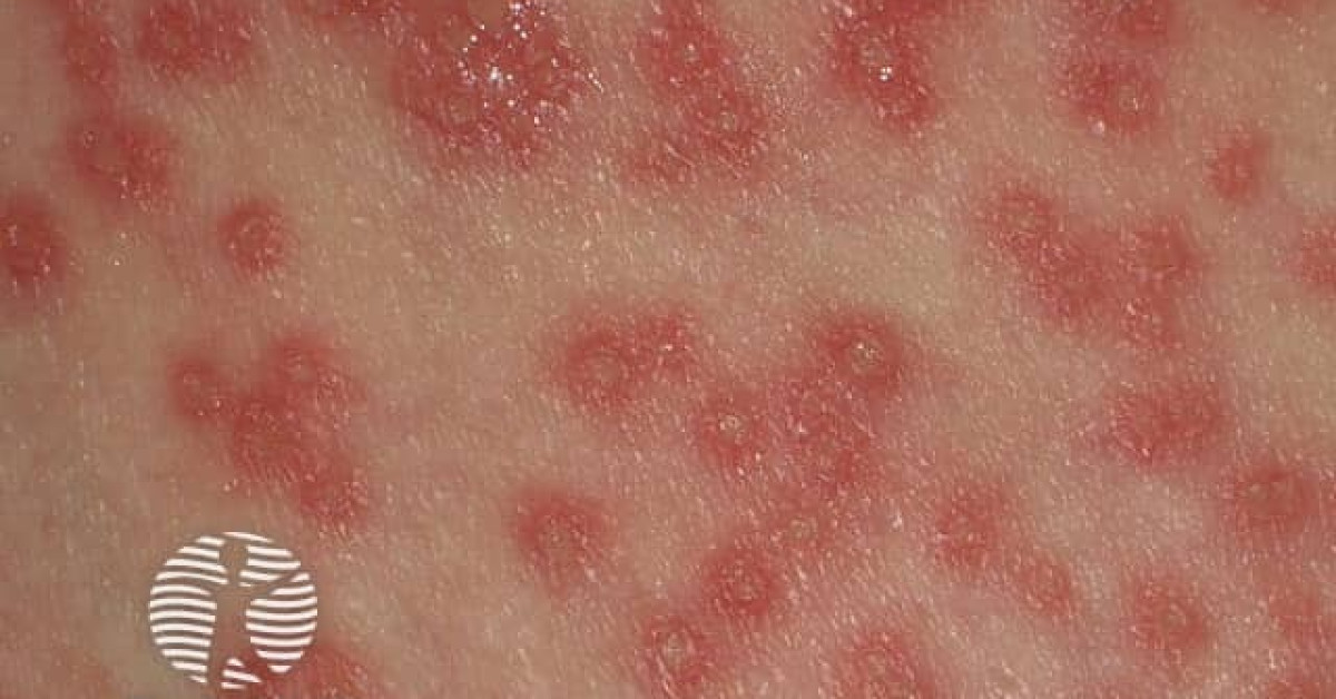 Eczema herpeticum image