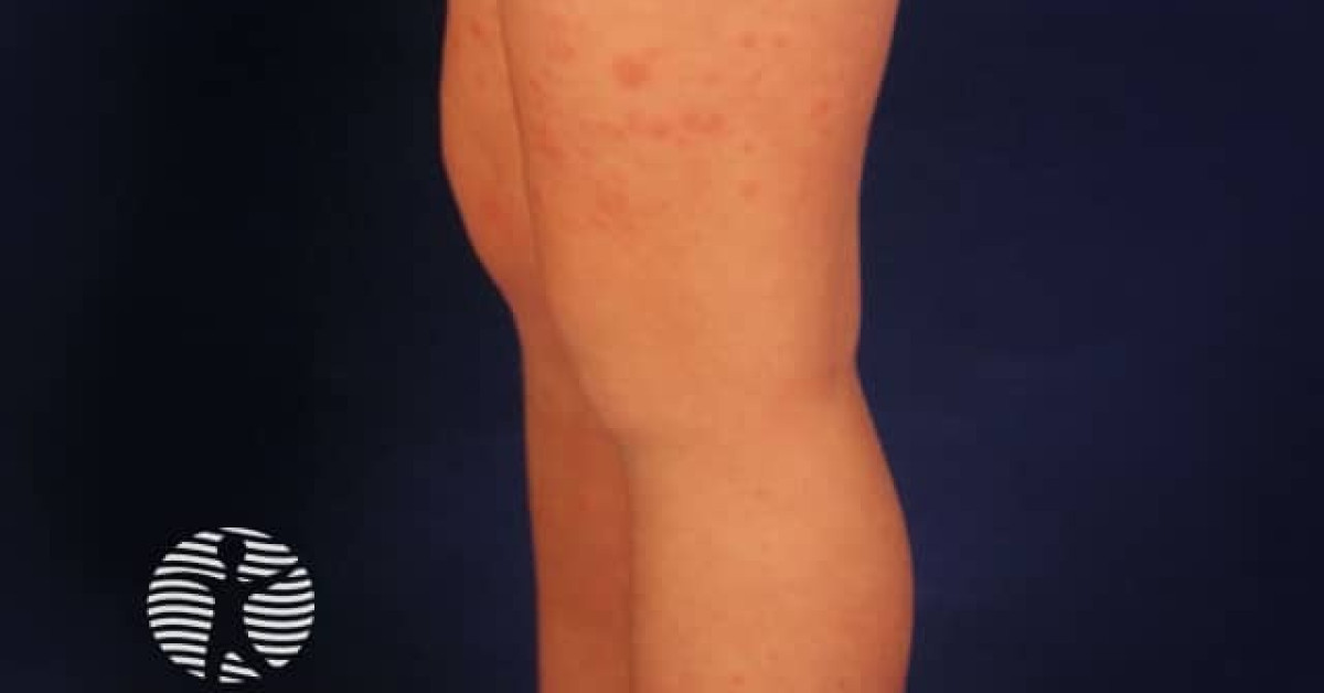 Gianotti-Crosti syndrome image