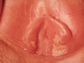 genital herpes on testicles