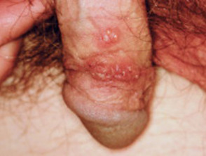 Genital herpes.