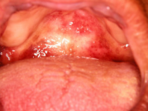 herpes on back of throat