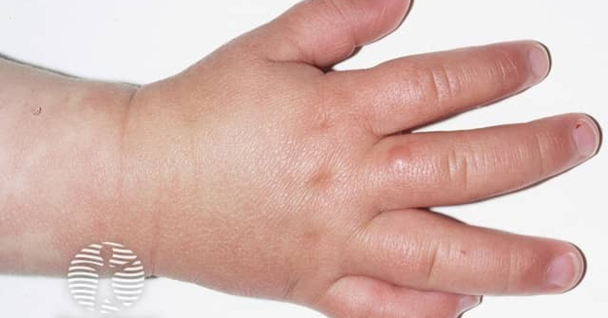 Hand foot and mouth disease image