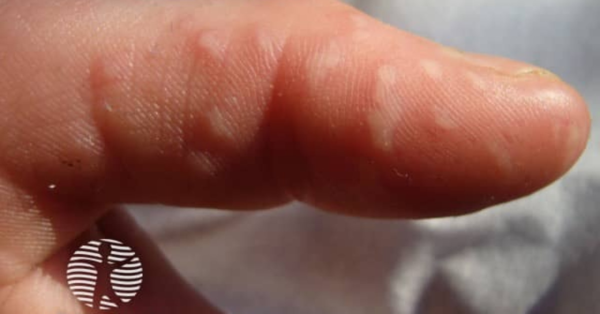 Hand foot and mouth disease image