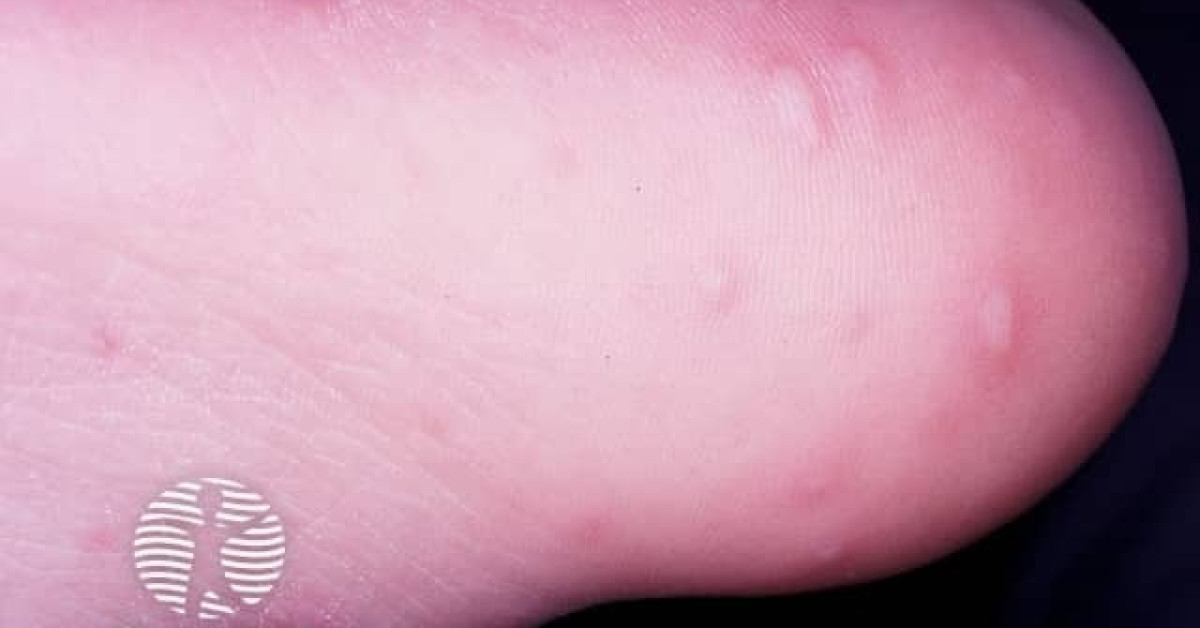 Hand foot and mouth disease image