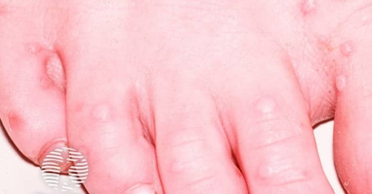 Hand foot and mouth disease image