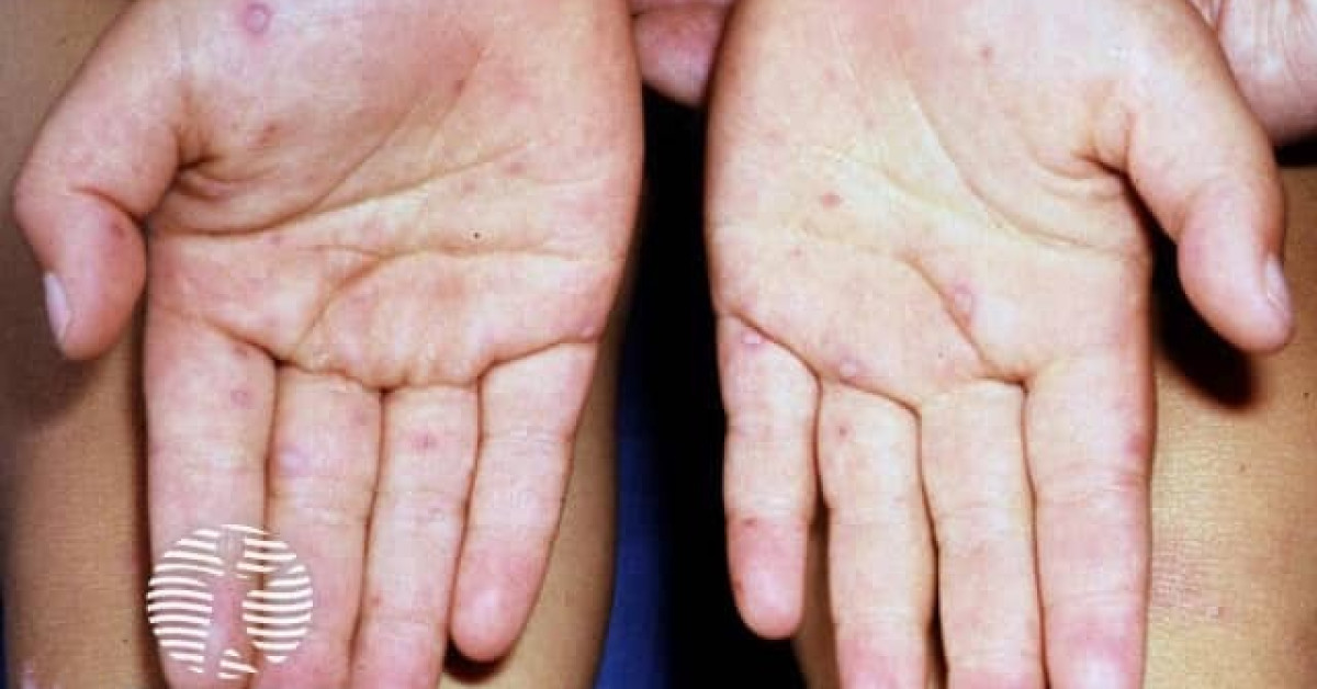 Hand foot and mouth disease image