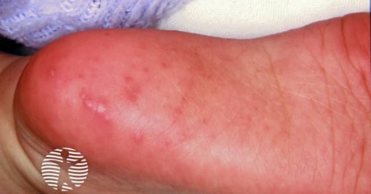 Hand foot and mouth disease image