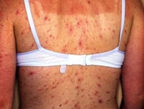 chickenpox in adults