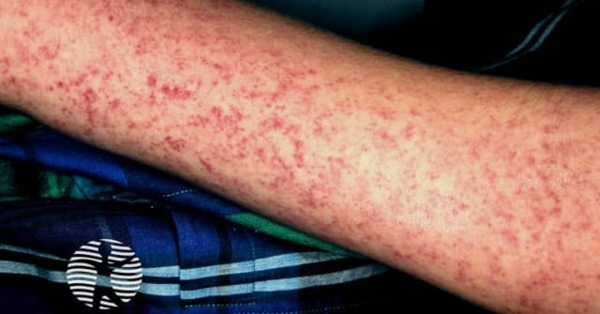 Measles image