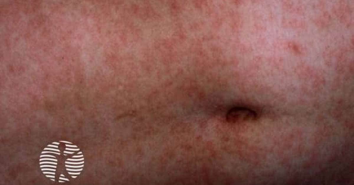 DermNet® - Measles image