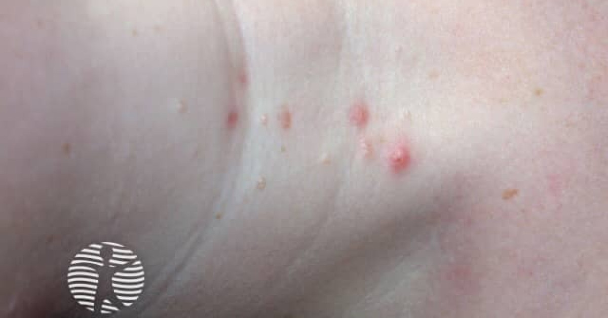 molluscum-contagiosum-image