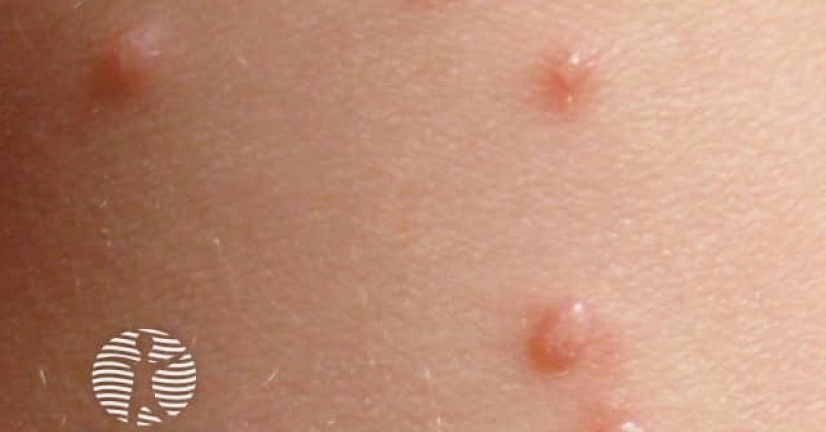 molluscum-contagiosum-image