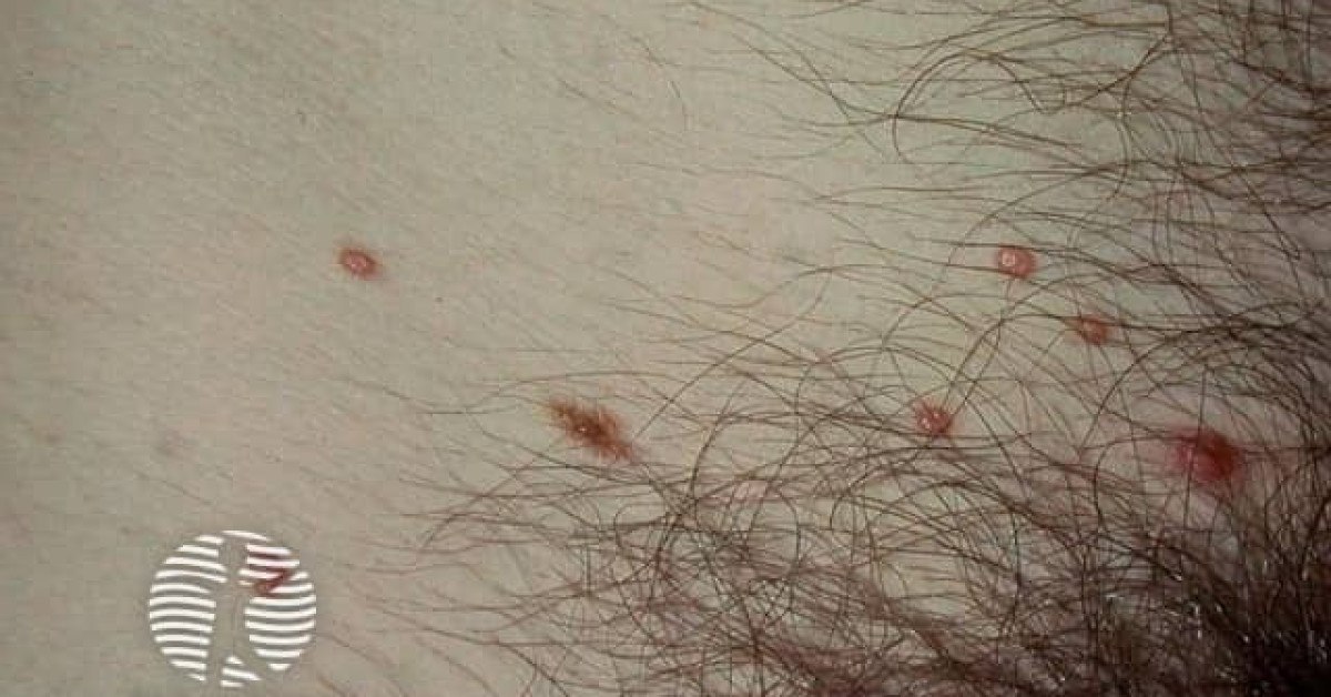 Molluscum contagiosum image