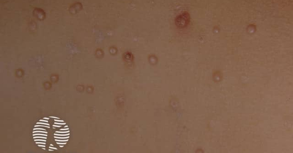 Molluscum contagiosum image