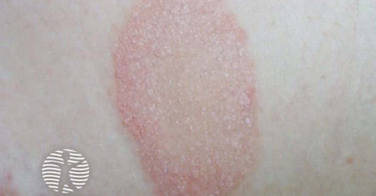 Dermnet® - Pityriasis Rosea Image