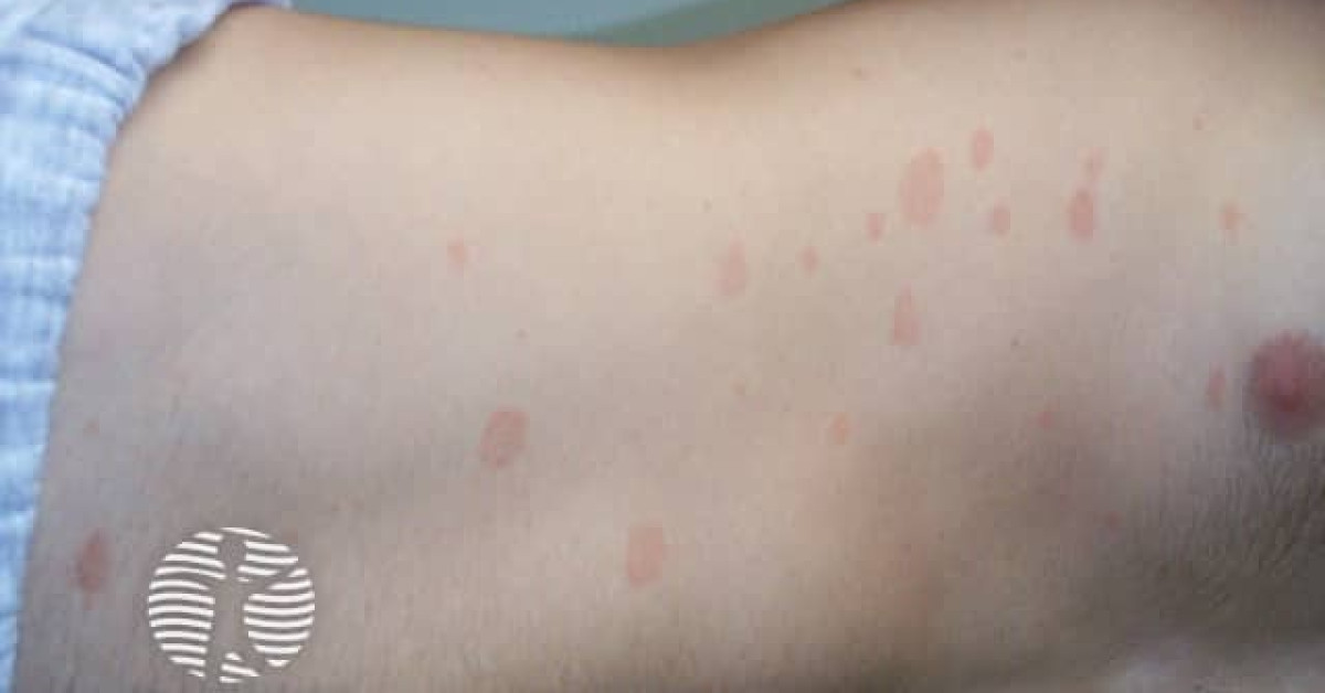 Pitotise Rocasea Rash Pityriasis rosea image