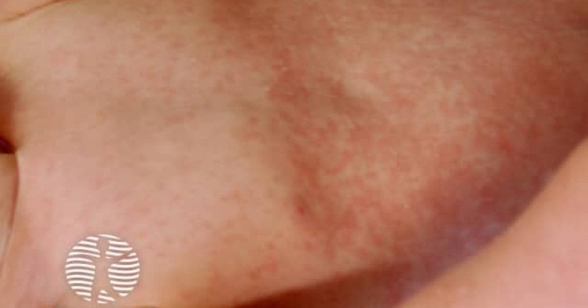 Rubella rash image